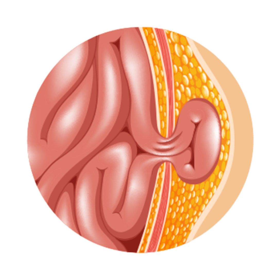 Hernia Surgery $3000